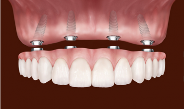 Diş kayıplarından sonra implant yaptırmazsam ne olur?