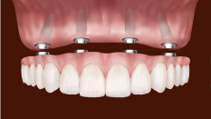 Diş kayıplarından sonra implant yaptırmazsam ne olur?